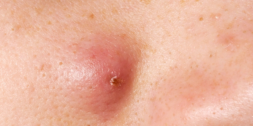 Chisturi sebacee