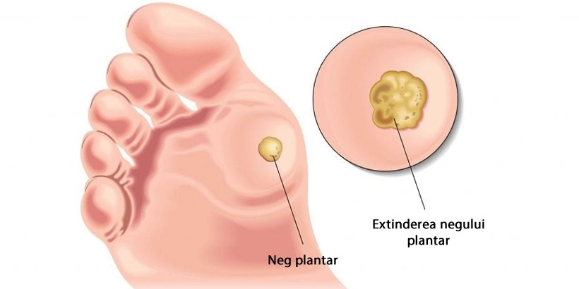 Electrocauterizare veruci plantare