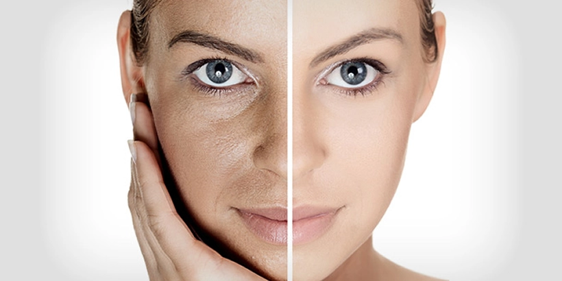 Rejuvenare facială
