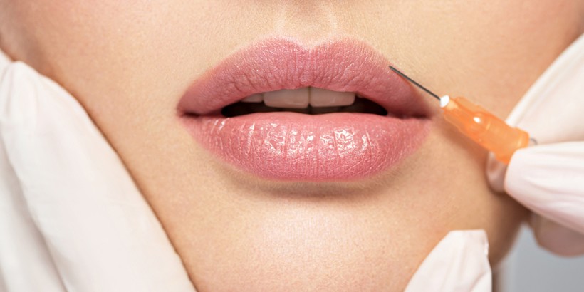 Lip augmentation - demo case 02