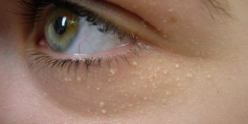 Tratament xantelasma